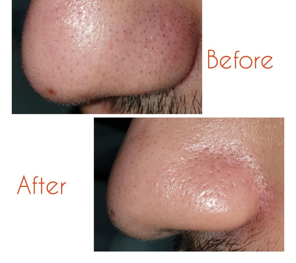 Trichstasis-spinulosa-Dr.-Uttam-Skin-and-Hair-6-e1655226978677